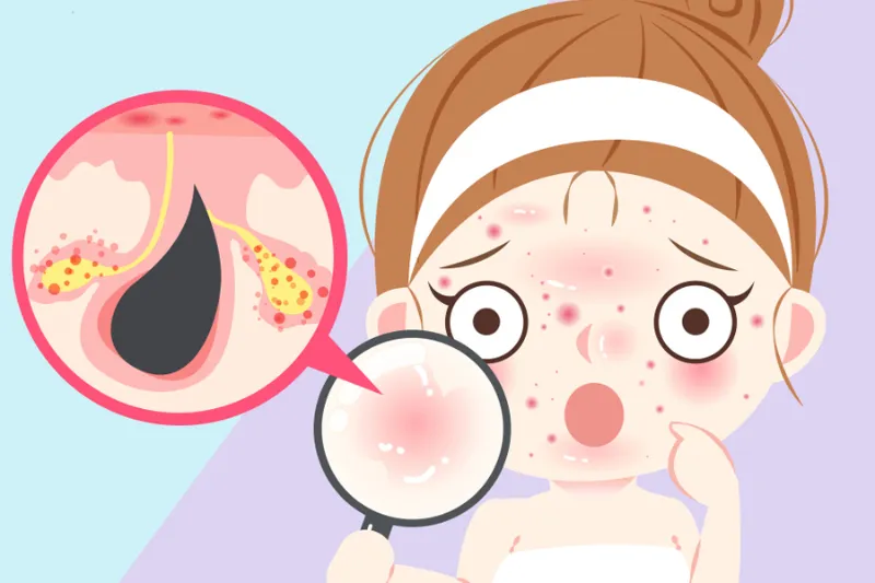 Mụn sẽ có xu hướng hình thành vào tuổi dậy thì