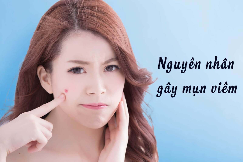 Các nguyên nhân gây mụn viêm phổ biến nhất hiện nay