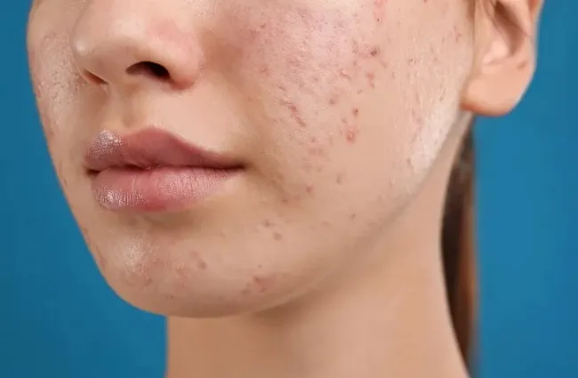 Làn da bị thâm mụn ở má và cằm