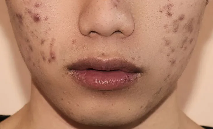 Nguyên nhân gây thâm mụn do Sắc tố melanin tăng do tiếp xúc với ánh nắng trực tiếp