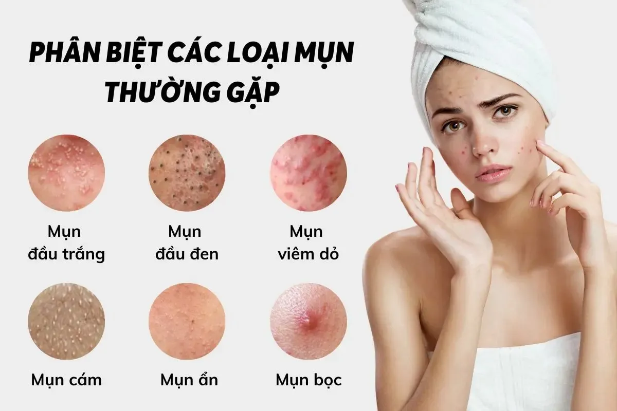 Các loại mụn ẩn thường gặp