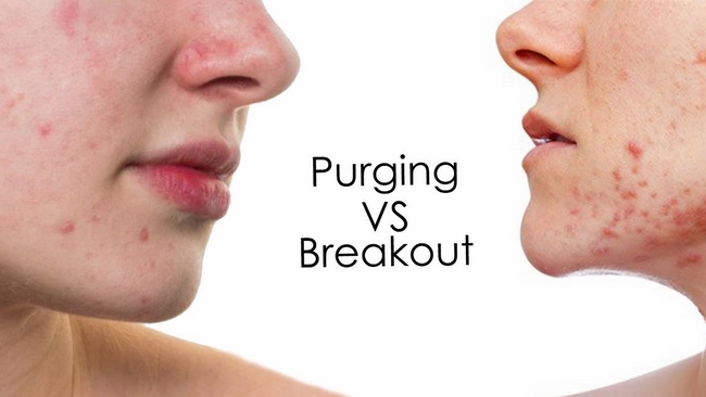 Hướng dẫn phân biệt đẩy mụn và kích ứng