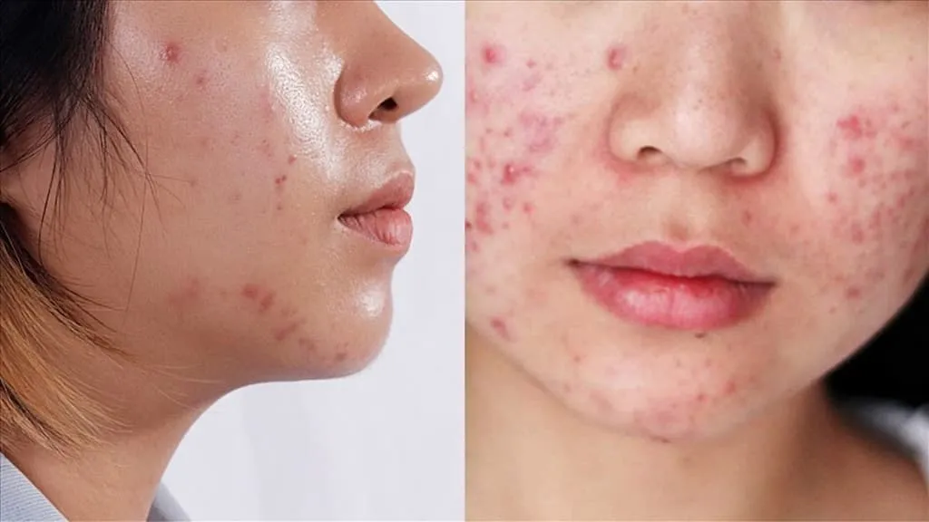 Hướng dẫn quy trình skincare cho da dầu mụn