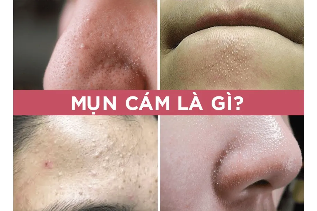 Mụn cám thường xuất hiện ở vùng mũi, cằm và trán