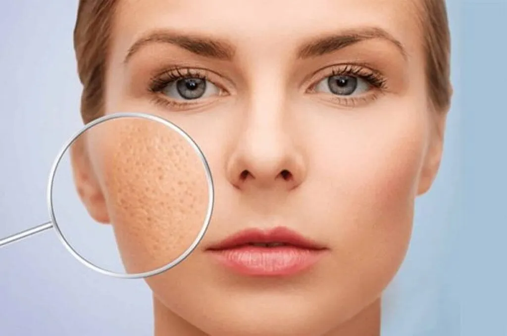 Da dầu mụn lỗ chân lông to là tình trạng khá phổ biến hiện nay