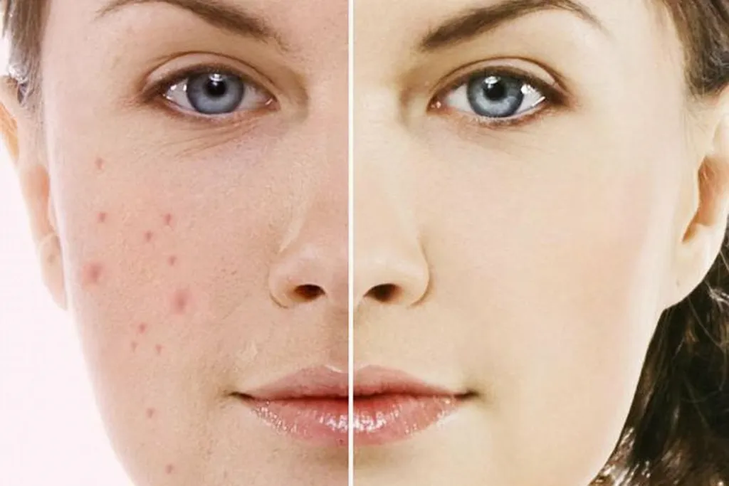 Chăm sóc da cẩn thận với một số lưu ý giúp quá trình trị thâm hiệu quả hơn