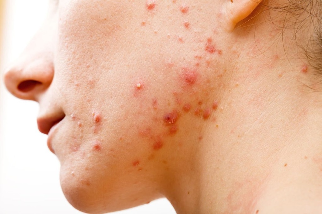 Điều gì sẽ xảy ra khi dùng sai sửa rửa mặt?