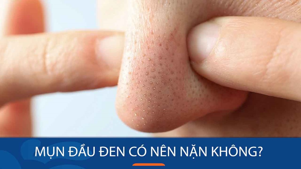Có nên tự lấy mụn đầu đen? 