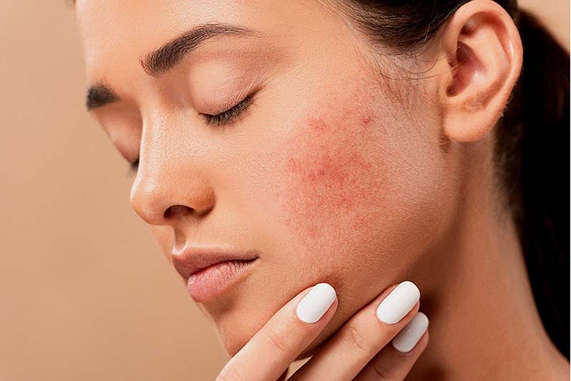 Tiêu diệt mụn ẩn mụn viêm 