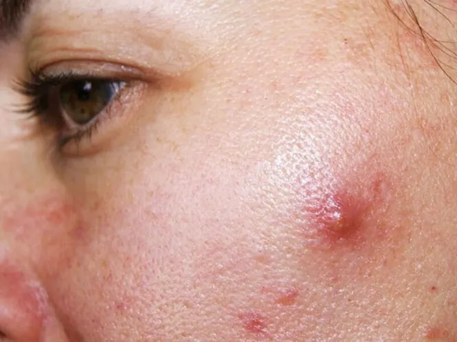 Mụn sưng đỏ do tích tụ bã nhờn
