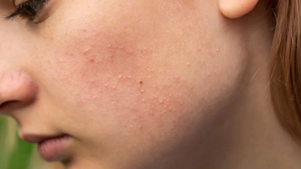Da bị nổi mụn nước dày đặc do viêm da tiếp xúc @vitaclinic