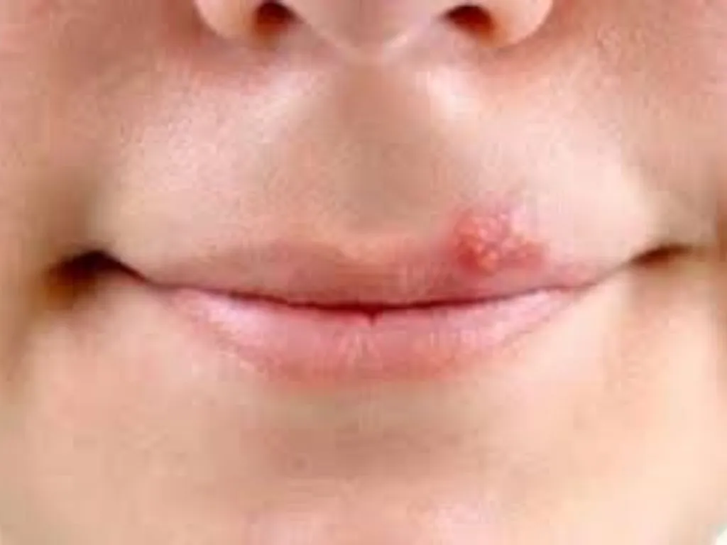 Biểu hiện của bệnh chốc mép @baosuckhoe
