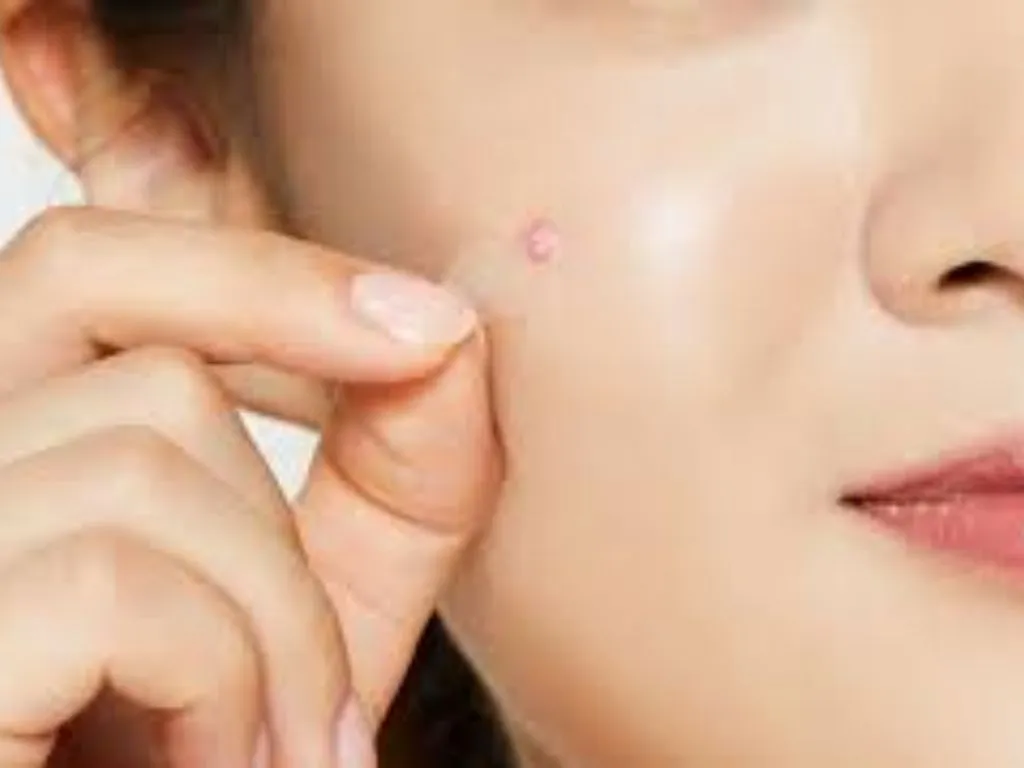 Miếng dán mụn nhỏ gọn @bachhoaxanh.com
