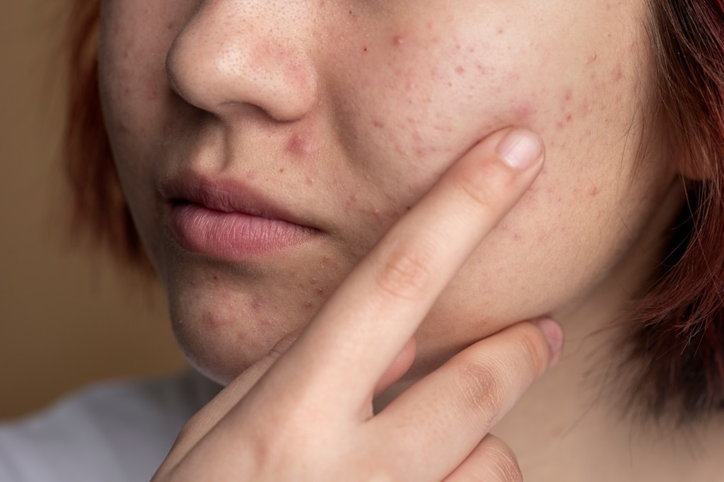 Công dụng của sản phẩm tuýp trị mụn ẩn