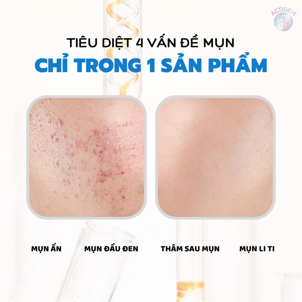 Thành phần nên có trong một tuýp trị mụn ẩn tốt?