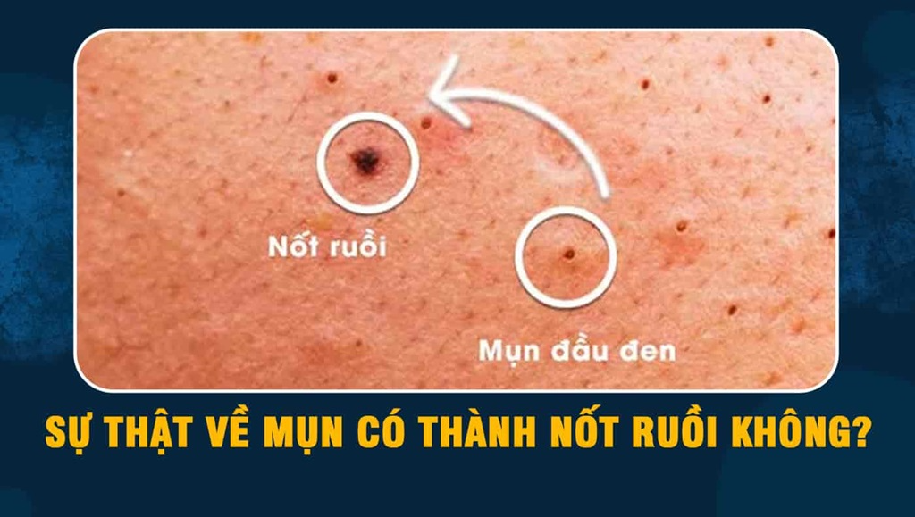 Mụn không nặn có biến thành nốt ruồi không?