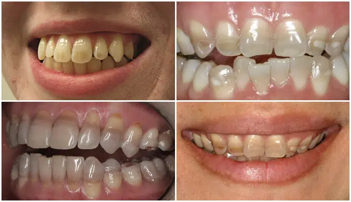 Ố răng do nhiễm kháng sinh khiến răng bị đen, xẩm màu, hoặc úa vàng