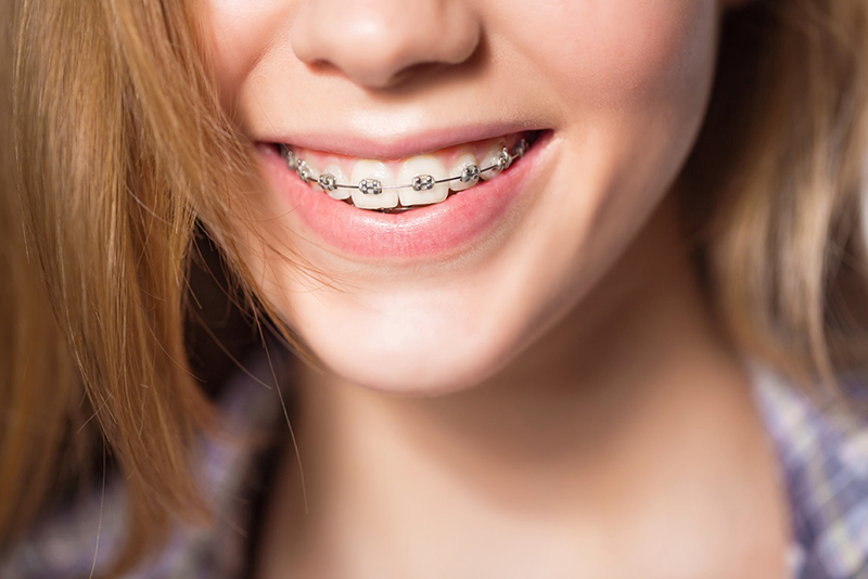 Chăm sóc răng miệng và dinh dưỡng như thế nào trong quá trình niềng răng?