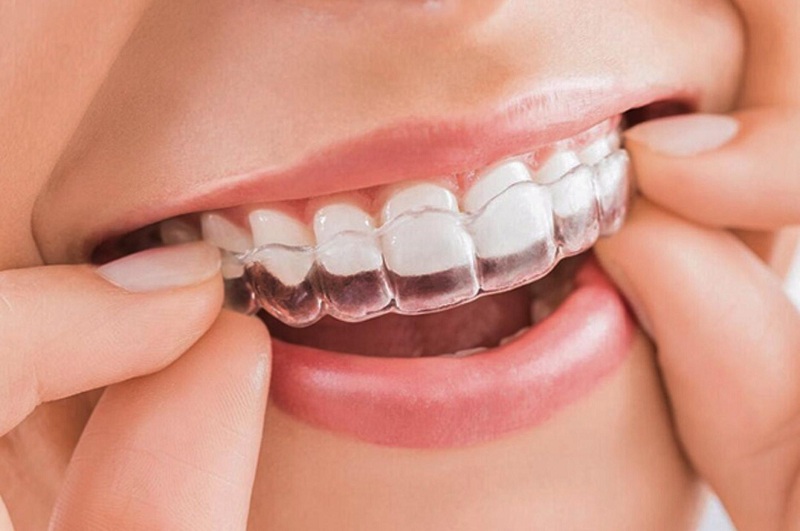 Giải đáp băn khoăn: Niềng răng có làm răng bị yếu không