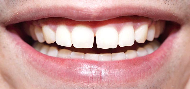 Giải đáp: Khi nào nên niềng răng để mang lại hiệu quả