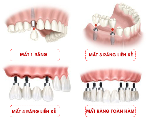 Cấy ghép Implant và quy trình cấy ghép Implant