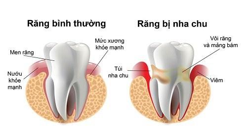 VIÊM NHA CHU – PHÒNG NGỪA TỐT HƠN LÀ CHỮA BỆNH