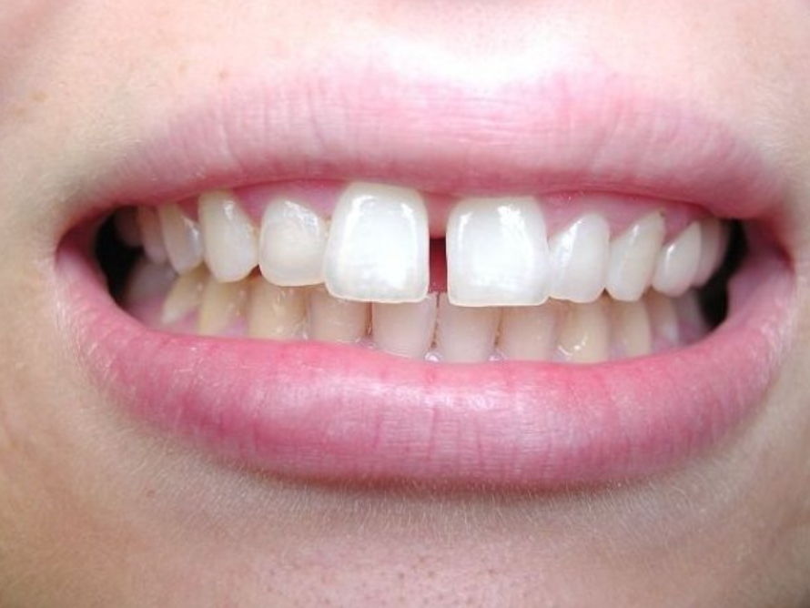Phục hình răng là gì? Có mấy phương pháp