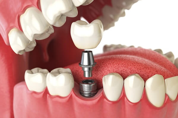 Phục hình răng sứ trên implant