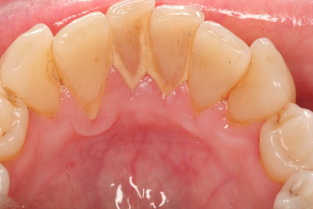 Cạo vôi răng có hại cho răng không?
