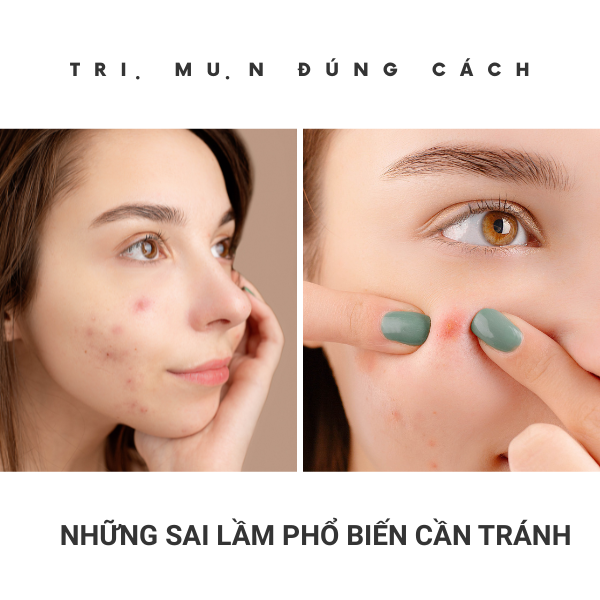 Trị mụn đúng cách: Những sai lầm phổ biến cần tránh
