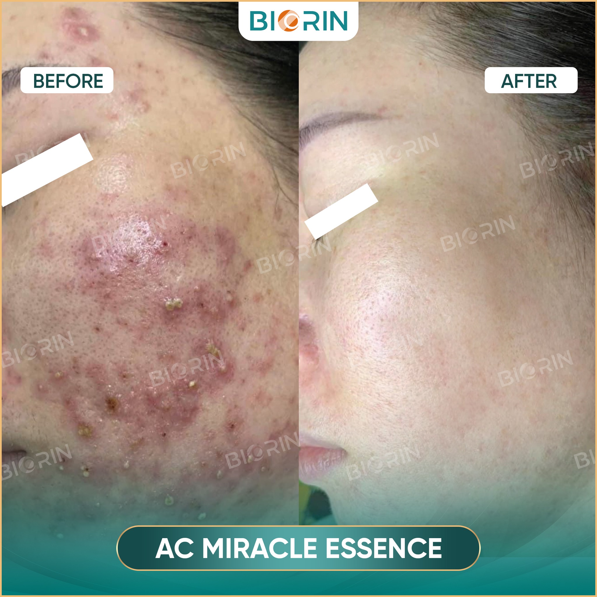 Meso mụn AC-Miracle Essence - Tinh chất ức chế đa vi khuẩn và vi nấm gây mụn - 3ml