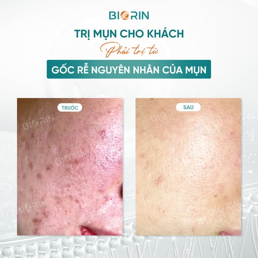 Meso mụn AC-Miracle Essence - Tinh chất ức chế đa vi khuẩn và vi nấm gây mụn - 3ml
