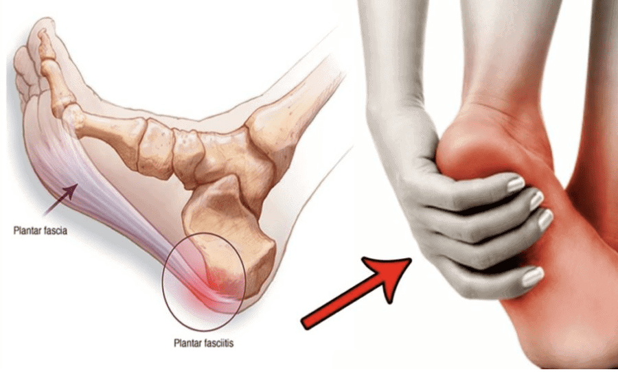 VIÊM CÂN GAN CHÂN (PLANTAR FASCIITIS)