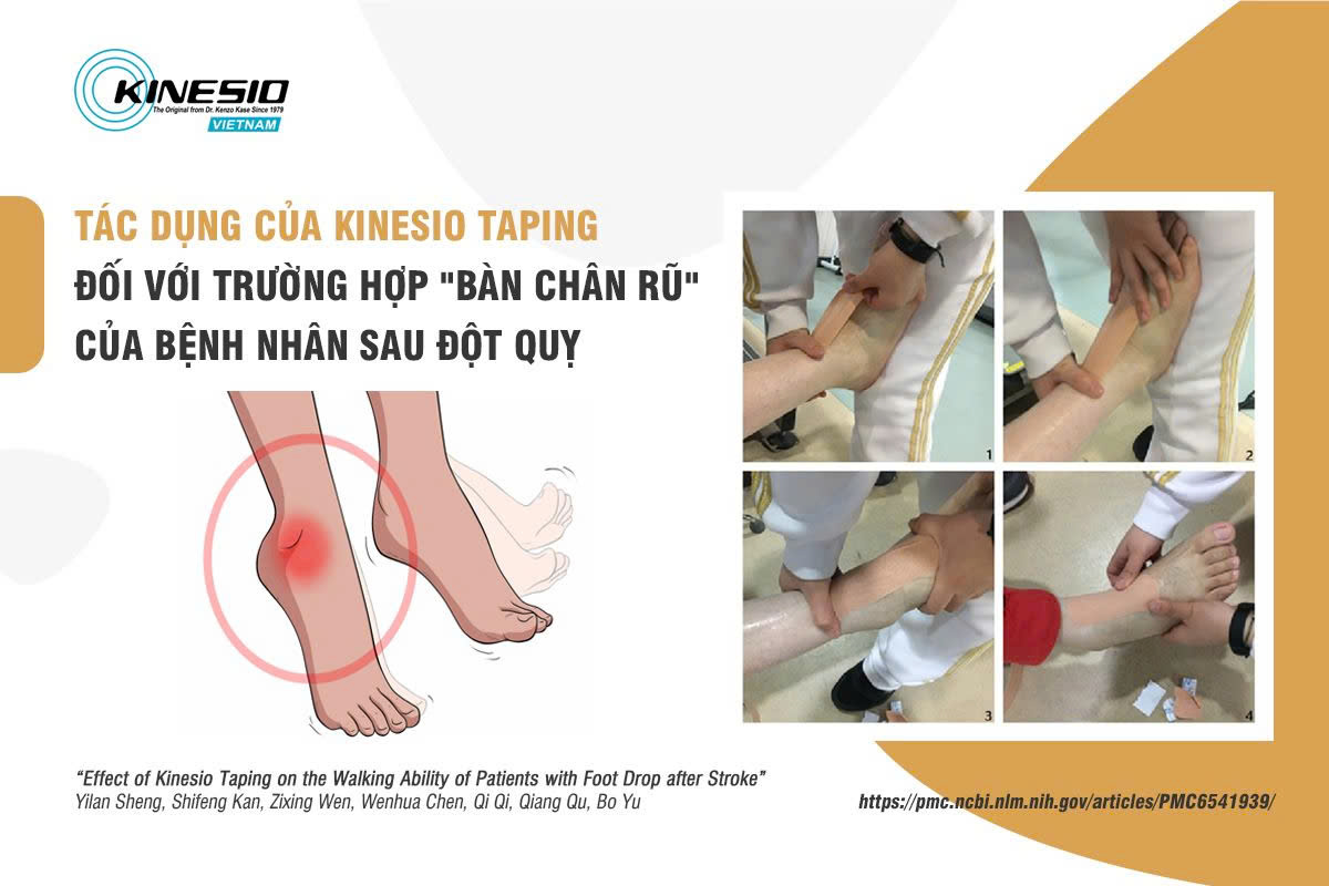 KINESIO TAPING HỖ TRỢ ĐIỀU TRỊ “HỘI CHỨNG BÀN CHÂN RŨ” CHO BỆNH NHÂN SAU ĐỘT QUỴ