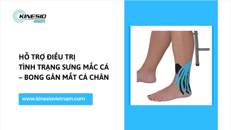 HƯỚNG DẪN CÁCH DÁN BĂNG KINESIO GIẢM SƯNG CỔ CHÂN