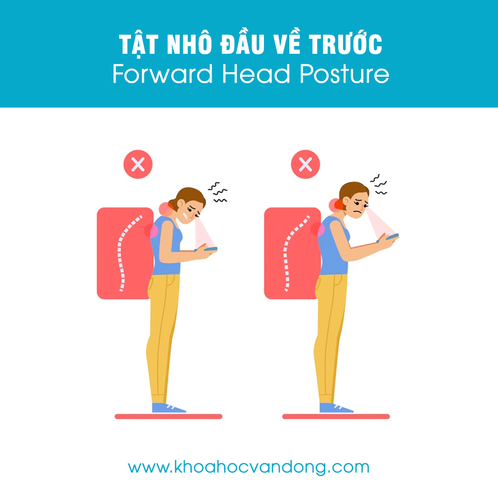 Tật nhô đầu về trước