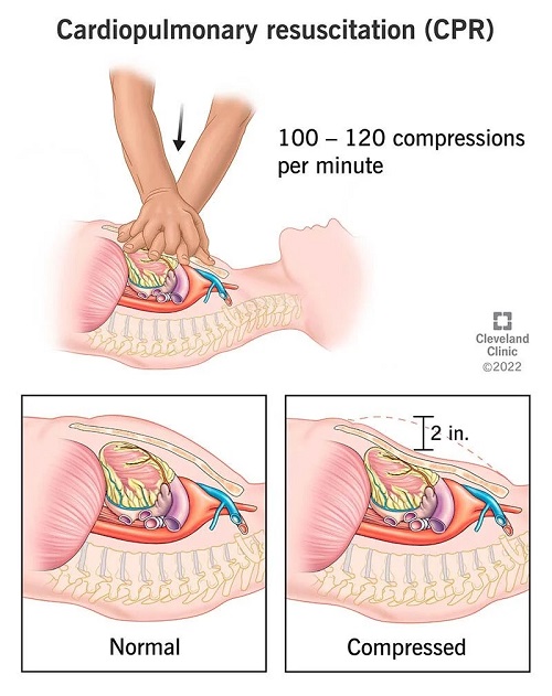 hướng dẫn cấp cứu ngừng tuần hoàn trên mô hình