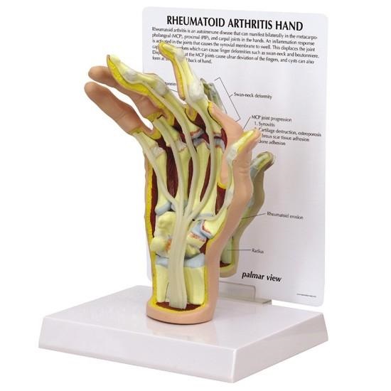 MÔ HÌNH BÀN TAY VIÊM KHỚP DẠNG THẤP (RA)
