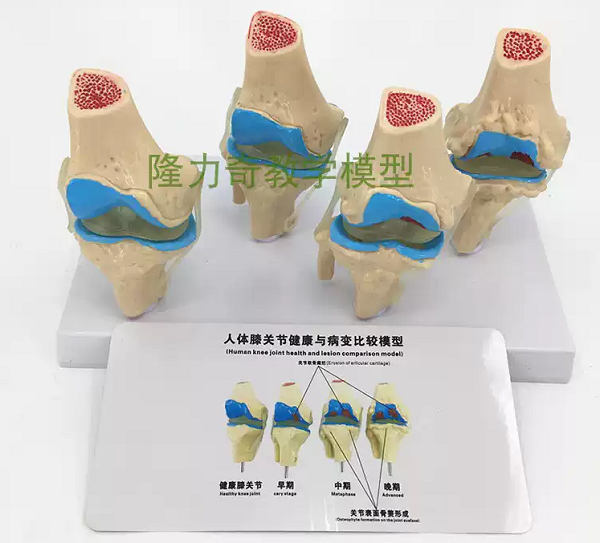 MÔ HÌNH GIẢNG DẠY BỆNH LÝ KHỚP GỐI