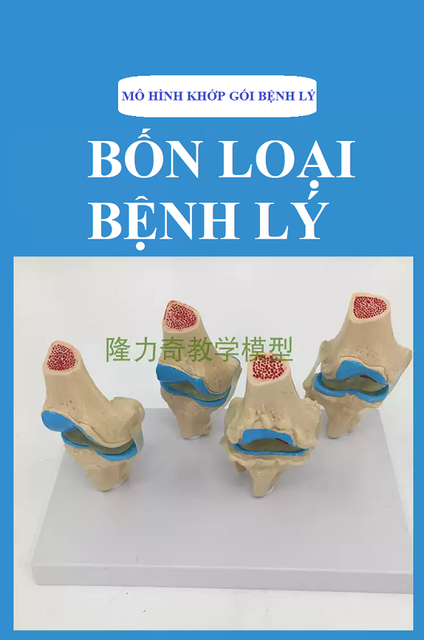 MÔ HÌNH GIẢNG DẠY BỆNH LÝ KHỚP GỐI