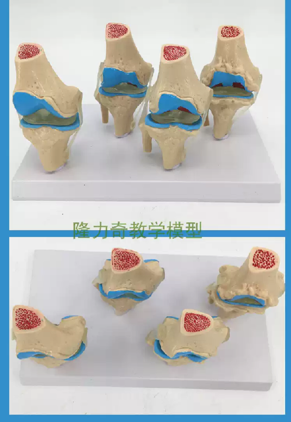 MÔ HÌNH GIẢNG DẠY BỆNH LÝ KHỚP GỐI