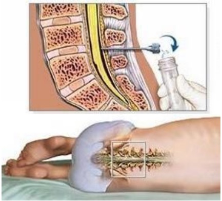 MÔ HÌNH THỰC HÀNH CHỌC DÒ TỦY SỐNG