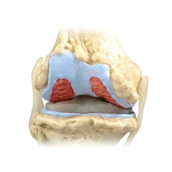 MÔ HÌNH THOÁI HÓA KHỚP GỐI 4 GIAI ĐOẠN