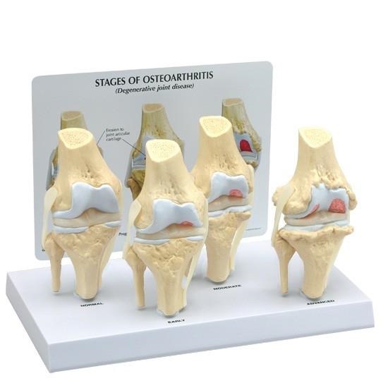 MÔ HÌNH THOÁI HÓA KHỚP GỐI 4 GIAI ĐOẠN