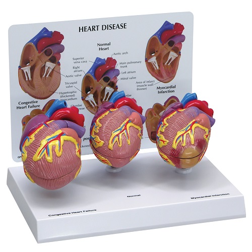Mô hình tim bệnh lý - Mô hình các bệnh về tim (3 tim)