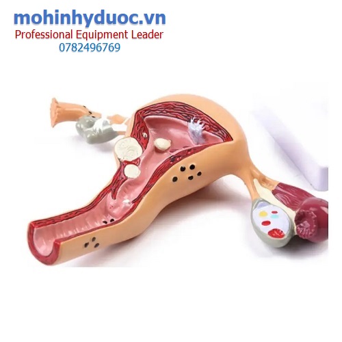 MÔ HÌNH TỬ CUNG - VÒI TRỨNG - BUỒNG TRỨNG BỆNH LÝ