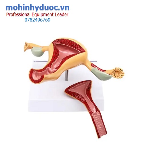 MÔ HÌNH TỬ CUNG - VÒI TRỨNG - BUỒNG TRỨNG BỆNH LÝ