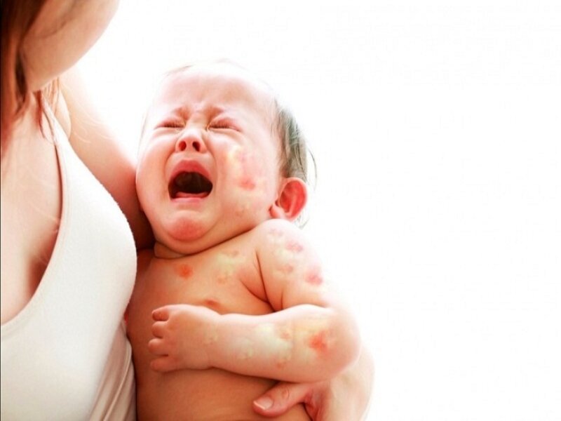 Bé bị dị ứng sữa tắm