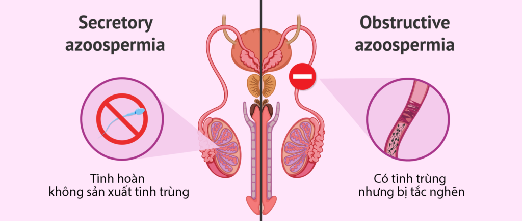 Các Nguyên Nhân Vô Sinh Ở Nam Giới Phổ Biến Hiện Nay – Cập Nhật 2026