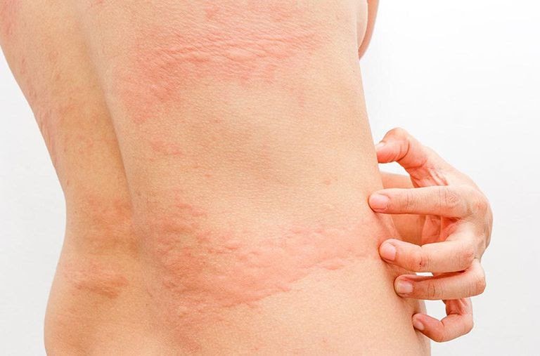 Bị Rệp Giường Cắn Có Sao Không? Những Mùi Hương Giúp Xua Đuổi Hiệu Quả